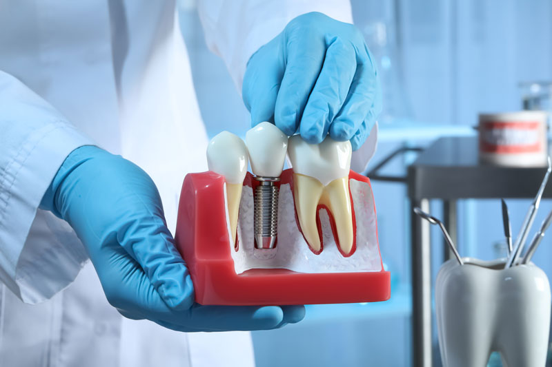 Enhancing Smiles with Dental Implants in Cincinnati, OH: All You Need to Know