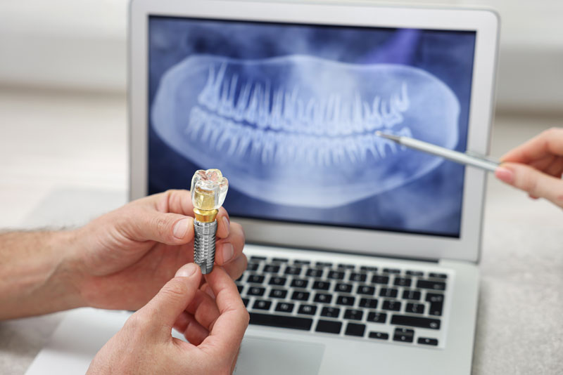 Longevity of Dental Implants: Causes and Fixes for Damages