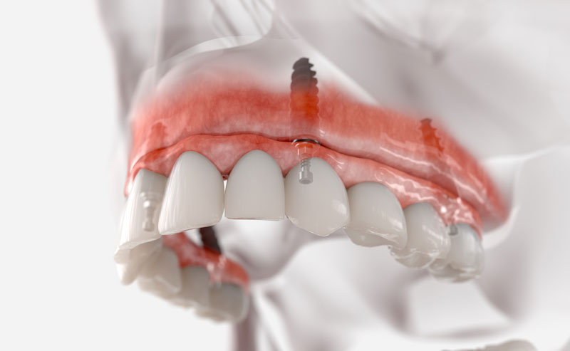 The Path to Smile Restoration: Secrets of Implants of Teeth