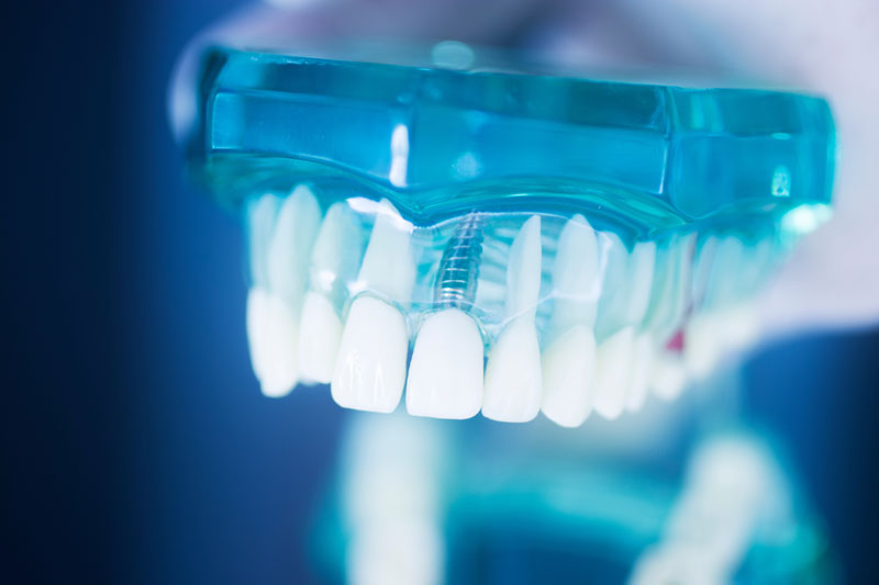 Discover the Promising World of Teeth Implants Today!