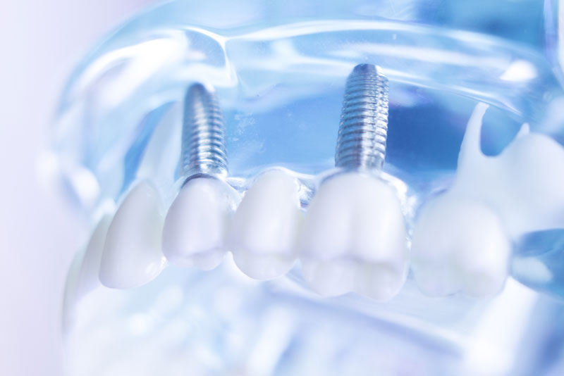 Taking A Closer Look At Dental Implants in Cincinnati, OH